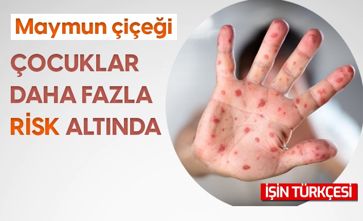 Maymun çiçeği virüsünde çocuklar daha fazla risk altında