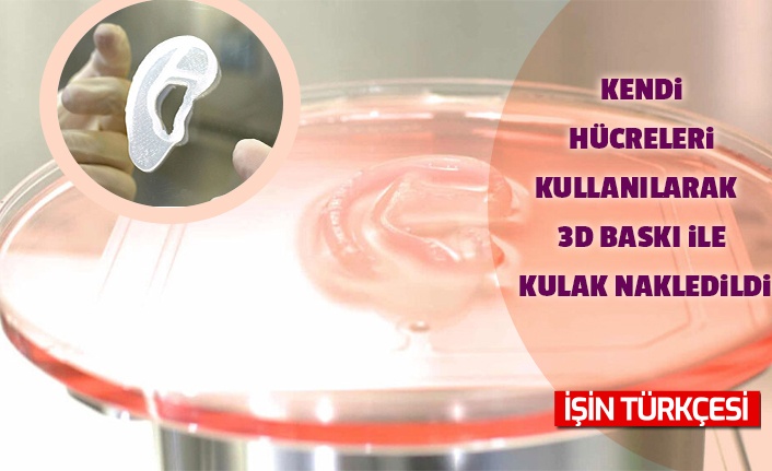 Kendi hücreleri kullanılarak 3D baskı ile kulak nakledildi