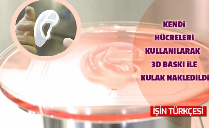 Kendi hücreleri kullanılarak 3D baskı ile kulak nakledildi